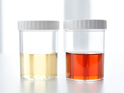 Blood In Urine Treatment In  Ghatkopar