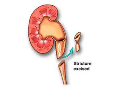 Pyeloplasty Treatment In  Ghatkopar