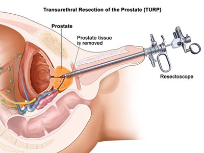 TURP Treatment In  Ghatkopar