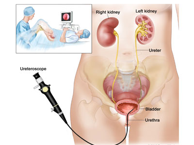 TURBT Treatment In  Ghatkopar