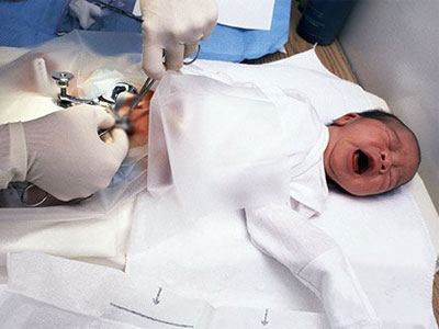 Circumcision Treatment In  Ghatkopar